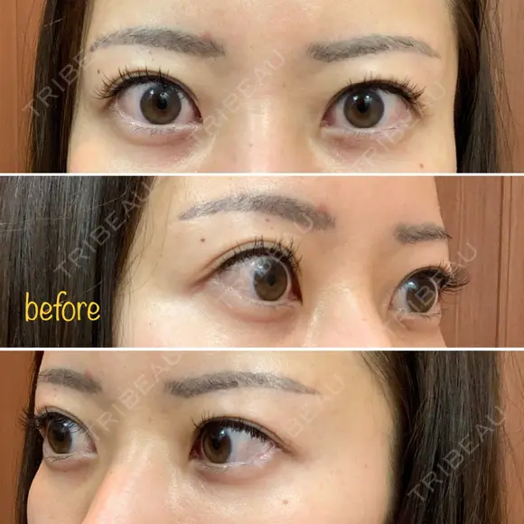 二重埋没 湘南美容クリニック 品川院 BEFORE メイン用