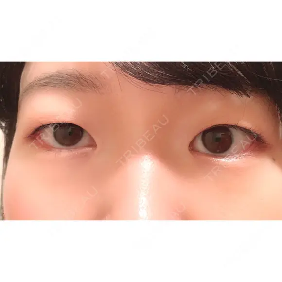 二重埋没 / 上まぶたの脂肪取り 湘南美容クリニック 水戸院 BEFORE メイン用