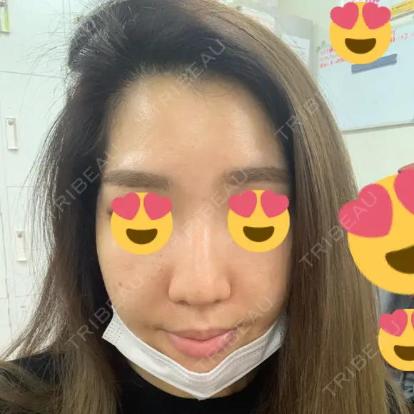 ヒアルロン酸注入（こめかみ） 湘南美容クリニック 京都院 BEFORE メイン用