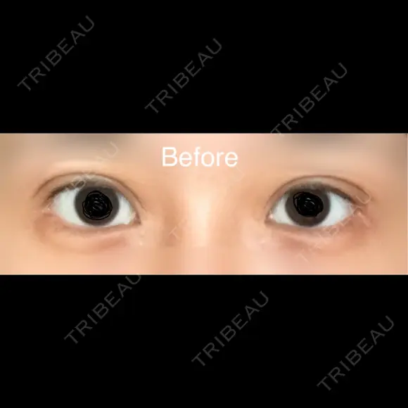 目尻切開 / 目尻靭帯移動 VARABON美容外科 BEFORE メイン用