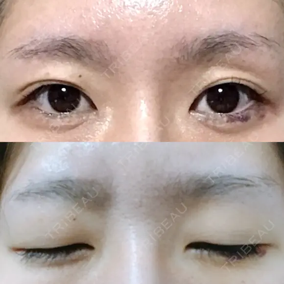 二重切開 松下皮フ形成外科 BEFORE メイン用