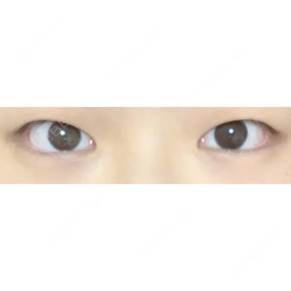 二重切開 / 目頭切開 東京イセアクリニック BEFORE メイン用