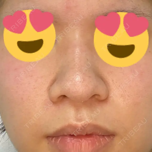 隆鼻術 / 鼻尖形成（切開） / 鼻中隔延長（切開） / 骨切幅寄せ 表参道スキンクリニック 表参道院 BEFORE メイン用