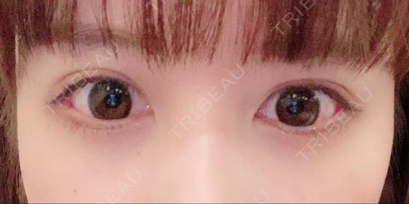 二重切開 / 上まぶたたるみ取り 酒井形成外科 BEFORE メイン用