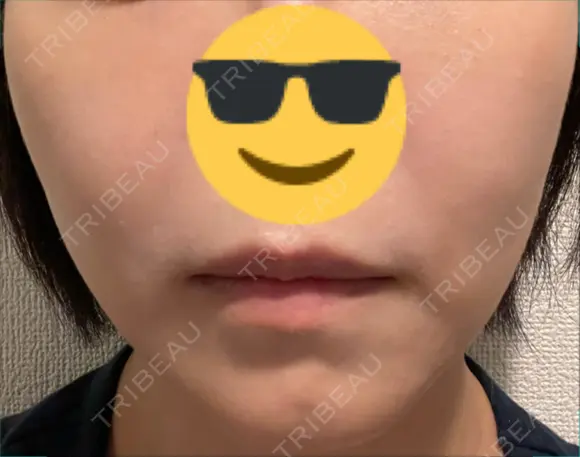 シミ取りレーザー / YAGレーザー PICO BEAUTY CLINIC BEFORE メイン用