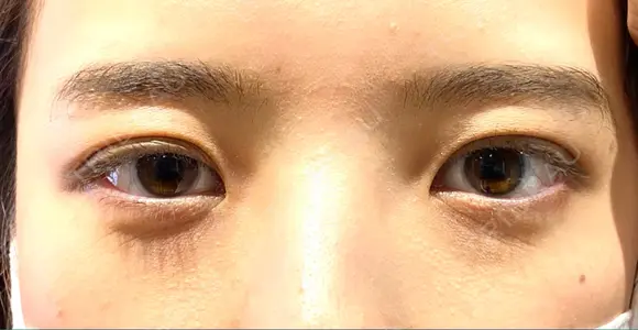 眉下切開 Taide Suenaga Clinic（タイデスエナガクリニック） BEFORE メイン用