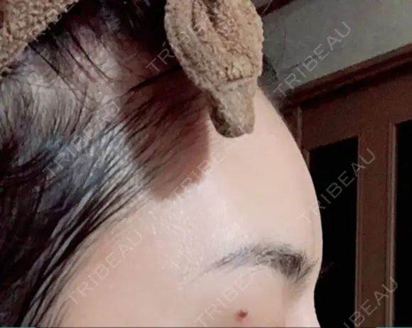 額を丸く / その他（輪郭） 品川美容外科 静岡院 BEFORE メイン用