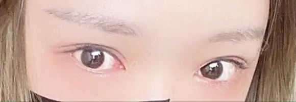 ヒアルロン酸注入（目の下） フィラークリニック 新宿院 BEFORE メイン用