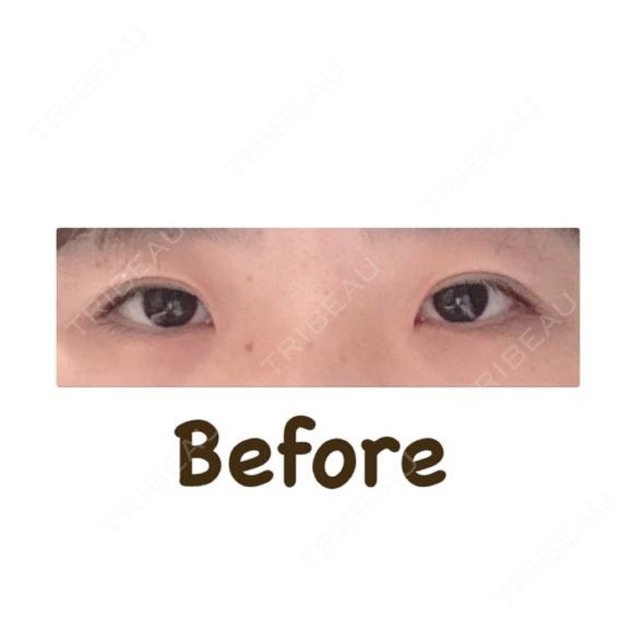 二重切開 城本クリニック 福岡院 BEFORE メイン用