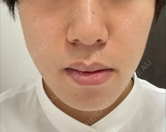 イオン導入 / 毛穴洗浄（ハイドラフェイシャルなど） Zetith Beauty Clinic 銀座院 BEFORE メイン用