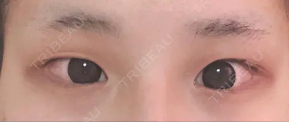 二重埋没 湘南美容クリニック 那覇院 BEFORE メイン用