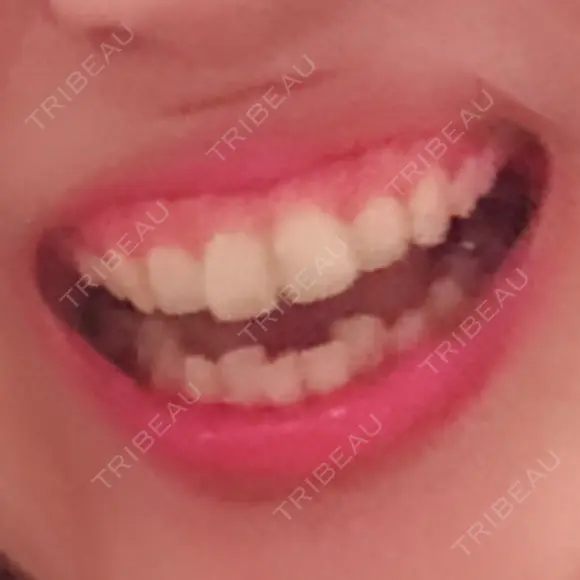 ガミースマイル手術 有楽町美容外科クリニック BEFORE メイン用