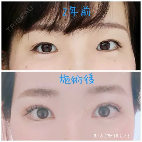 二重埋没 / 目頭切開 目白ポセンシアクリニック BEFORE メイン用
