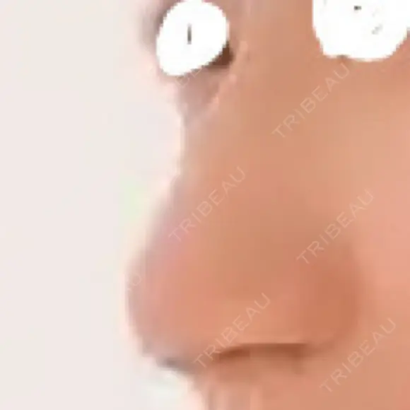 隆鼻術 アネシス美容クリニック BEFORE メイン用