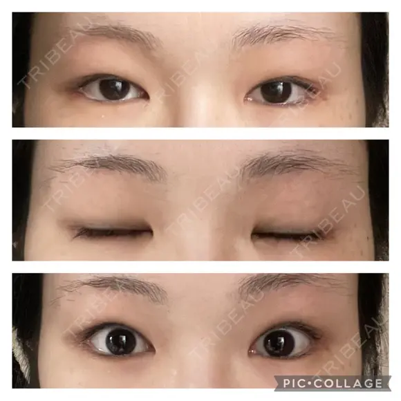 二重切開 / 目頭切開 / 眼瞼下垂（切開） / 上まぶたの脂肪取り 銀座マイアミ美容外科 BEFORE メイン用