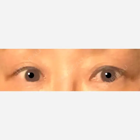 二重切開 / 上まぶたたるみ取り 表参道スキンクリニック 表参道院 BEFORE メイン用