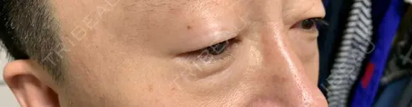 眼瞼下垂（切開） 湘南美容クリニック 船橋院 BEFORE メイン用