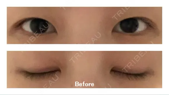 二重埋没 湘南美容クリニック 藤沢院 BEFORE メイン用