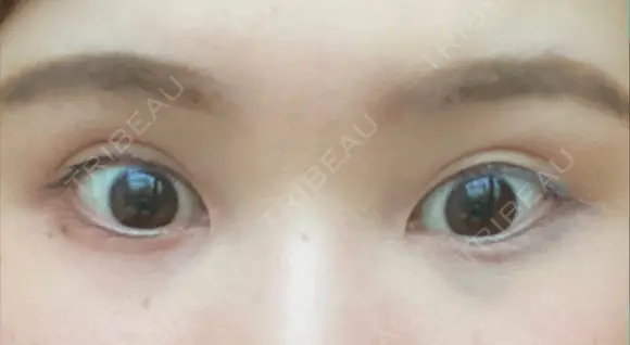 目尻切開 / タレ目形成・グラマラスライン（切開） ビスポーククリニック 福岡院 BEFORE メイン用