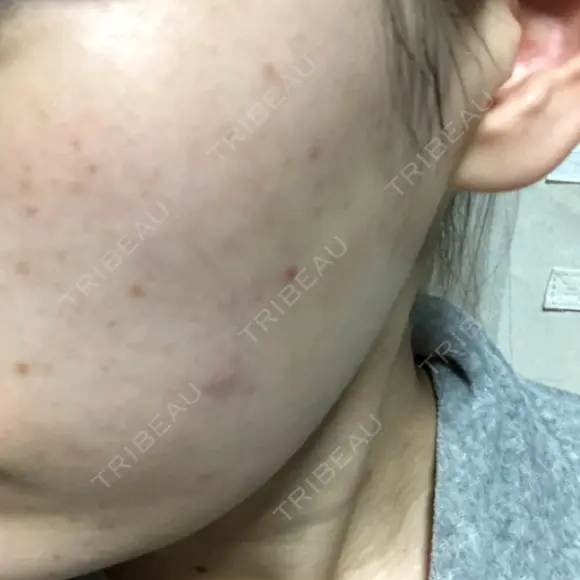 美肌レーザー / シミ取りレーザー たかはし形成外科･美容外科  BEFORE メイン用