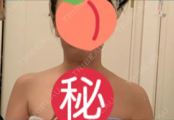 ボトックス（肩） 湘南美容クリニック 藤沢院 BEFORE メイン用