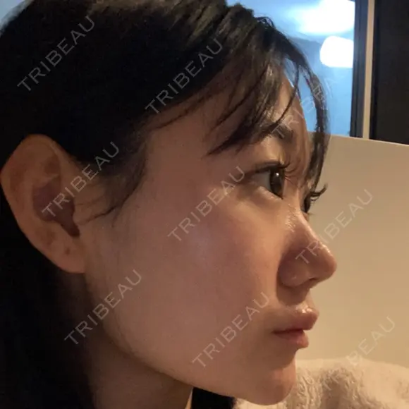 ヒアルロン酸注入（頬） 赤坂プレミアクリニック BEFORE メイン用