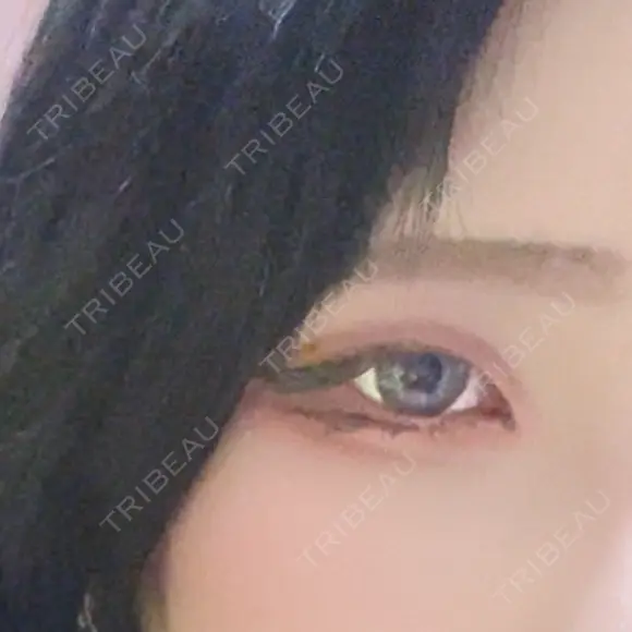ヒアルロン酸注入（涙袋） イデア美容皮膚科クリニック 千葉船橋院 BEFORE メイン用