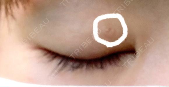 その他（目元） アロマ美容外科クリニック BEFORE メイン用