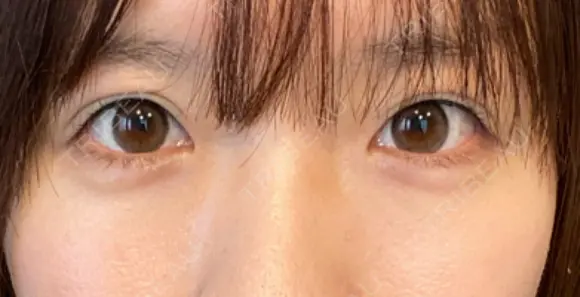 ヒアルロン酸注入（涙袋） 新宿ビューティークリニック 新宿院 BEFORE メイン用