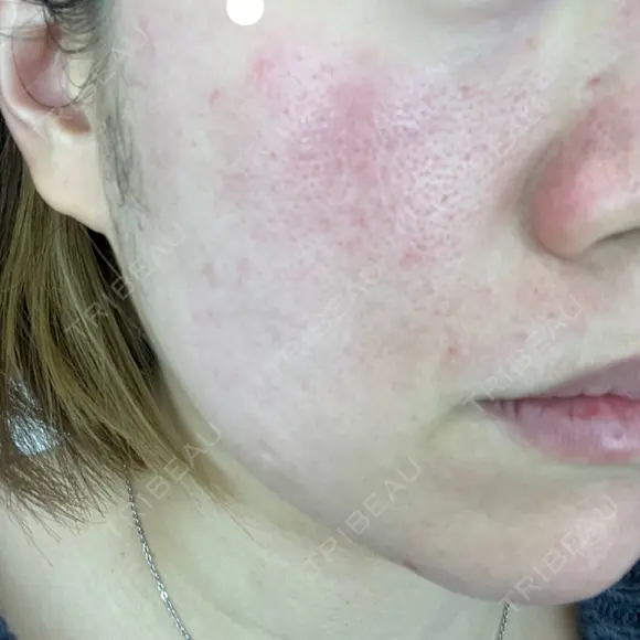ピーリング（ニキビ・毛穴） / ダーマペン Zetith Beauty Clinic 銀座院 BEFORE メイン用