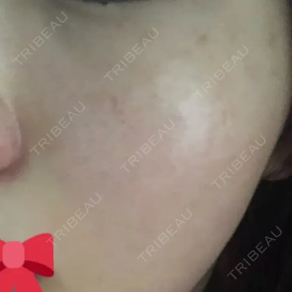 糸リフト ニューセンス皮膚科クリニック BEFORE メイン用