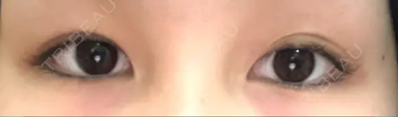 二重切開 / 上まぶたたるみ取り / 目元修正 サラ美容外科 BEFORE メイン用