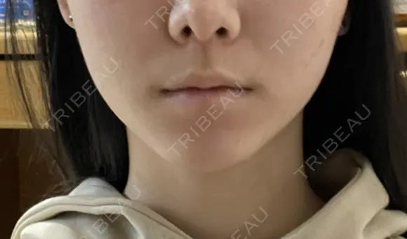 脂肪吸引（顔） Mods Clinic（モッズクリニック） 東京院 BEFORE メイン用