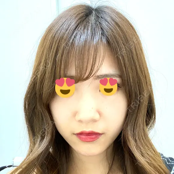 スレッドノーズ / ヒアルロン酸注入（鼻） / 脂肪溶解注射（顔） / その他（鼻） TCB東京中央美容外科 池袋西口院 BEFORE メイン用