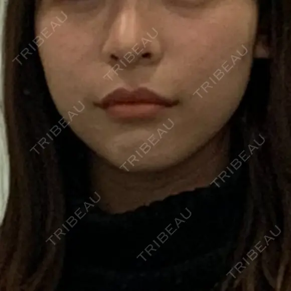 糸リフト / 骨切り（あご） / 脂肪吸引（顔） / ボトックス（エラ・小顔） 銀座マイアミ美容外科 BEFORE メイン用