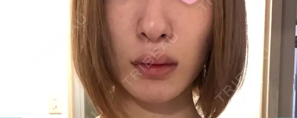 鼻尖形成（切開） 銀座マイアミ美容外科 BEFORE メイン用