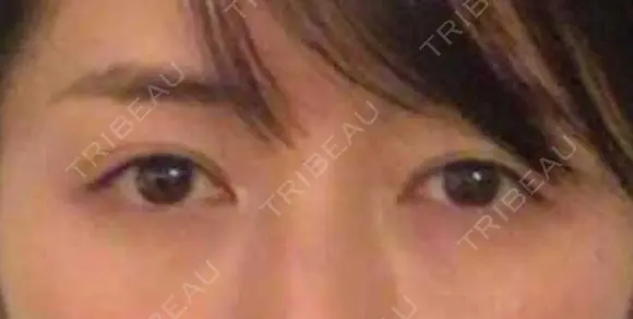 クマ治療 APOLLO BEAUTY CLINIC BEFORE メイン用