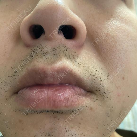 医療脱毛（顔） 自由が丘クリニック BEFORE メイン用