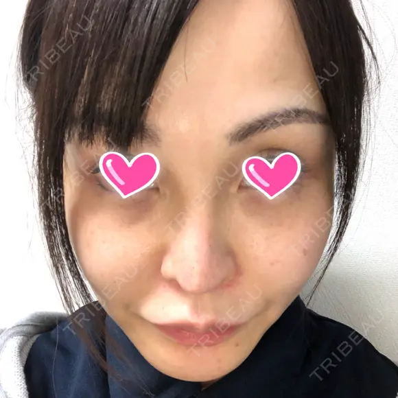 隆鼻術 / 鼻尖形成（切開） / 鼻中隔延長（切開） / 軟骨移植 / プロテーゼ除去 / 鼻修正 THE ROPPONGI CLINIC（ザ 六本木クリニック） BEFORE メイン用