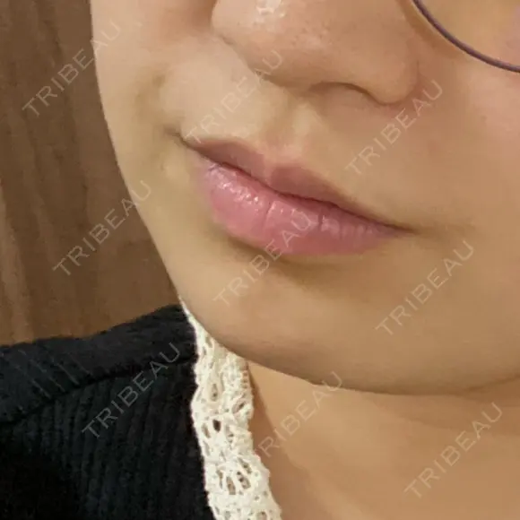 アートメイク（唇） BMC CLINIC 南青山 BEFORE メイン用