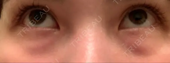 下まぶたの脂肪取り 品川美容外科 仙台院 BEFORE メイン用