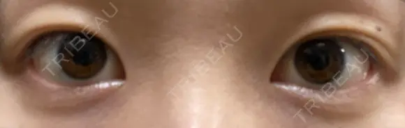 二重埋没 湘南美容クリニック 藤沢院 BEFORE メイン用