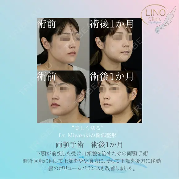 《両顎手術（顎矯正手術；ルフォー1、BSSO、オトガイ形成）》の症例 | トリビュー