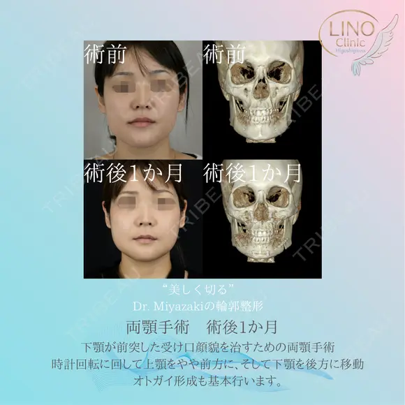 《両顎手術（顎矯正手術；ルフォー1、BSSO、オトガイ形成）》の症例 | トリビュー