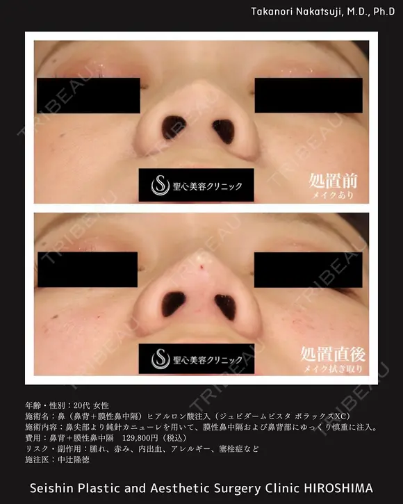 20代女性・洗練された美鼻】鼻ヒアルロン酸（鼻背+膜性鼻中隔）ジュビダーム ボラックスXC（直後）》の症例 | トリビュー