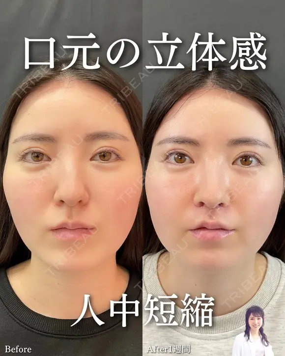 《人中短縮》の症例 | トリビュー