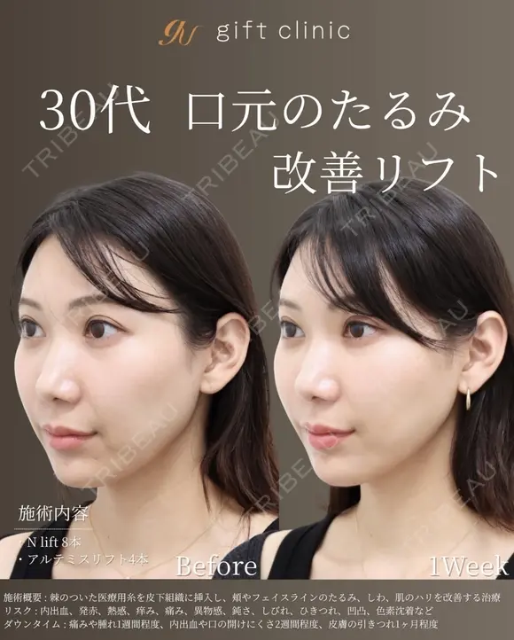 《30代 | 口周り改善リフト》の症例 | トリビュー