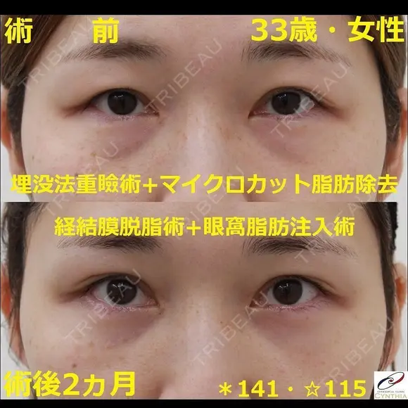 《くま治療＋埋没法重瞼術＋マイクロカット脂肪除去（上眼瞼経皮的除脂術）》の症例 | トリビュー