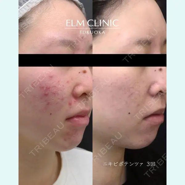 美容皮膚科エルムクリニック 京都院の症例