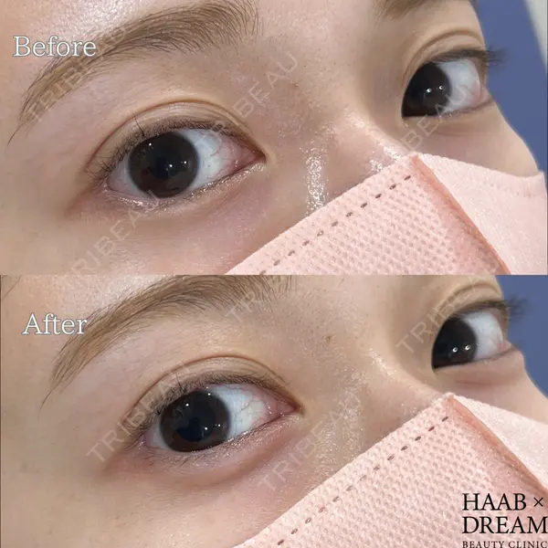 HAAB×DREAM BEAUTY CLINIC 東京本院 佐野 圭医師の症例
